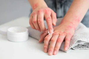 Eczema skincare